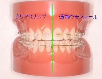 矯正装置|埼玉県所沢市 歯列矯正