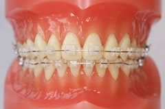 セラミックブラケットと金属のワイヤー